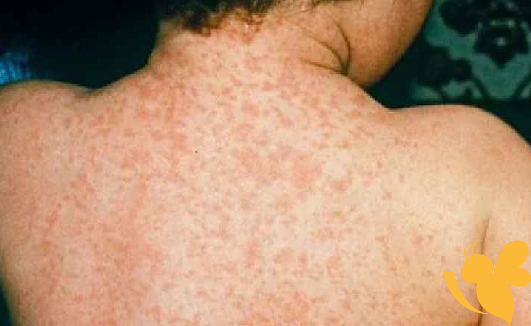Measles outbreak linked to international flight at Denver airport raises alarm