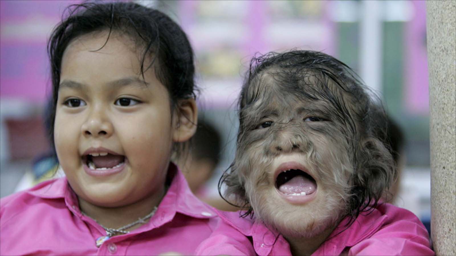 Urgent Advisory: Hair Regrowth Drug Associated with Werewolf Syndrome