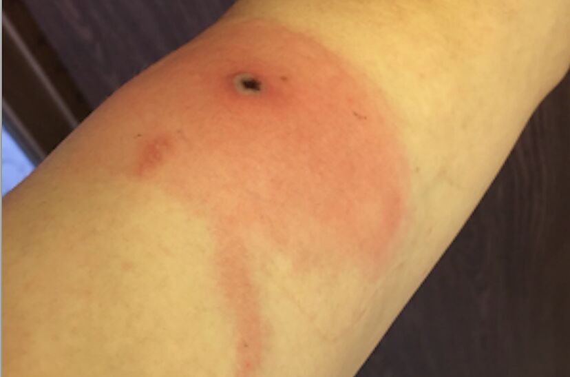 Virus Alaskapox symptoms, signs, and what to know about