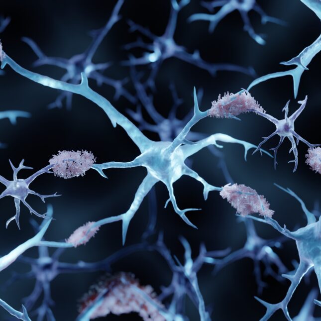 Study Suggests Anti-Amyloid Therapy Could Delay Alzheimer’s Symptoms in Some Patients